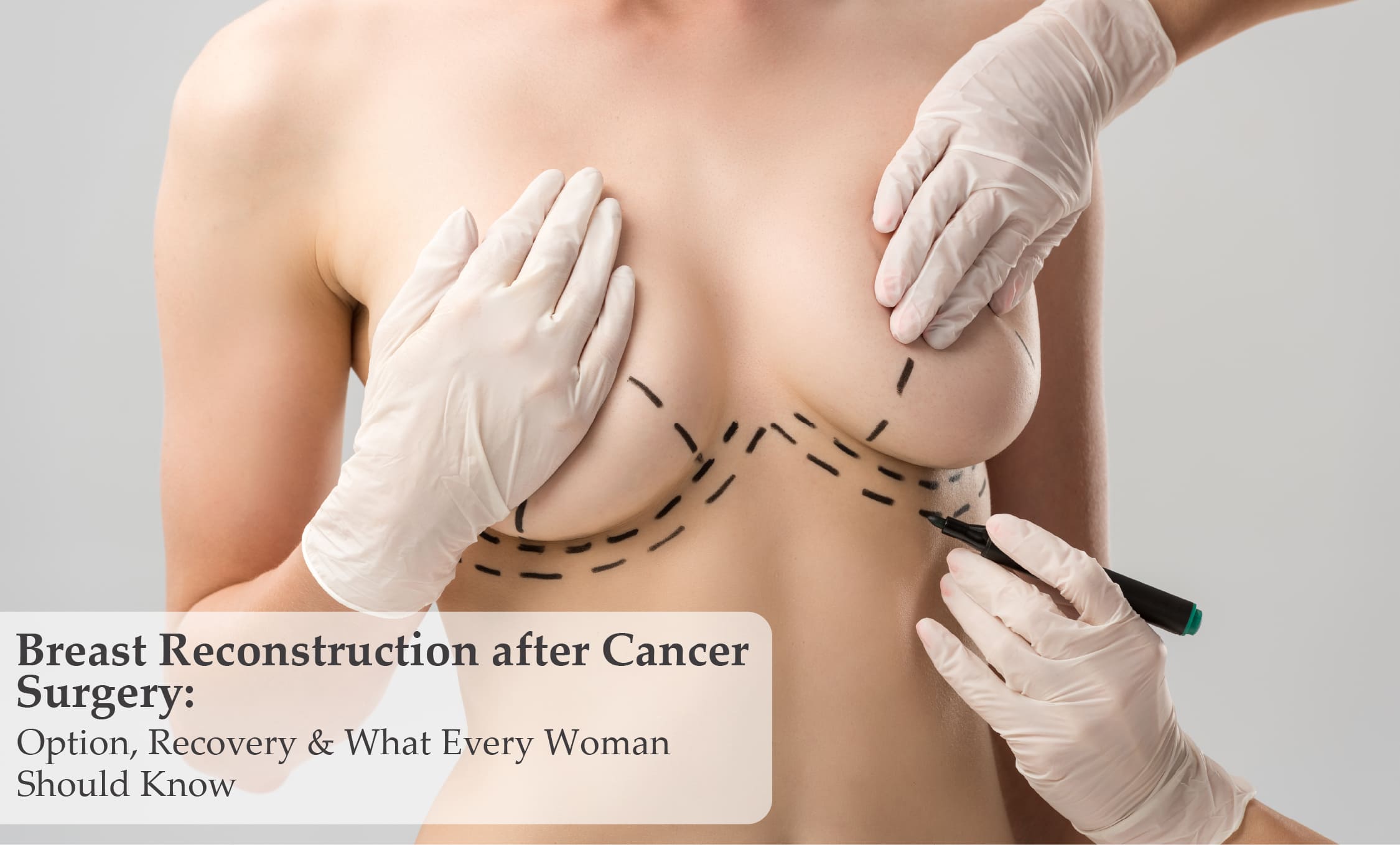 Breast Reconstruction After Cancer Surgery in Mumbai