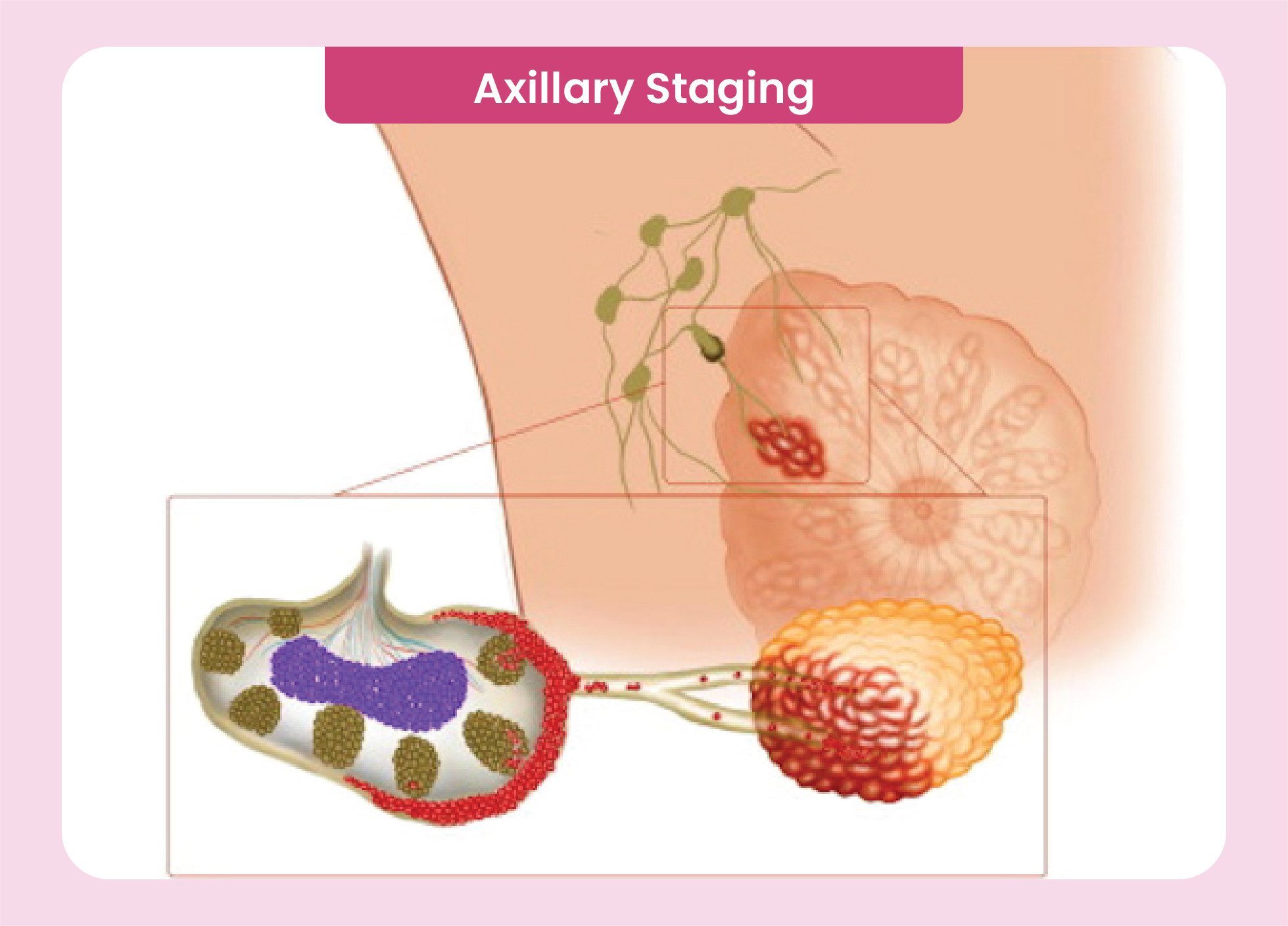 Axillary Staging in Breast Cancer - Sentinel Lymph Node Biopsy