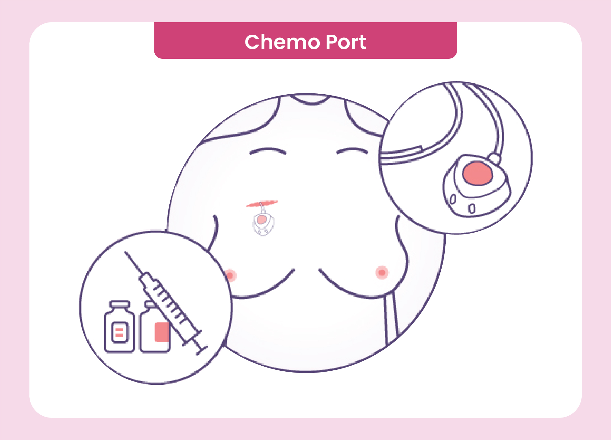Chemo Port Device - Easy Access for Chemotherapy